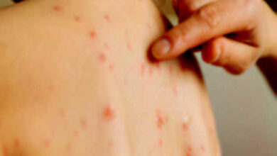 Measles on the rise in Sri Lanka