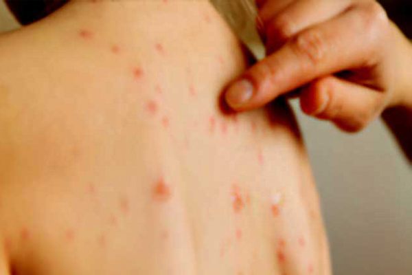 Measles on the rise in Sri Lanka