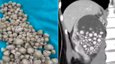 300 stones removed from the kidney of a young woman