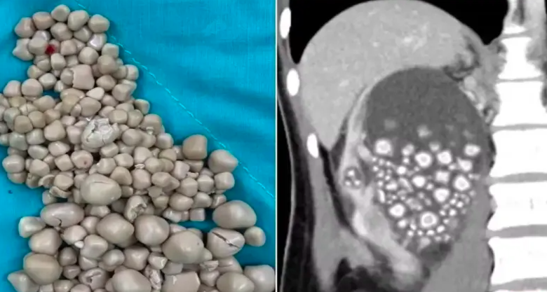 300 stones removed from the kidney of a young woman